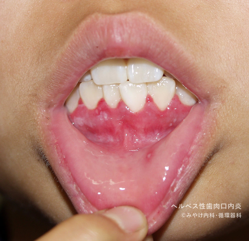 ヘルペス性（歯肉）口内炎-写真11　歯肉の発赤・腫脹