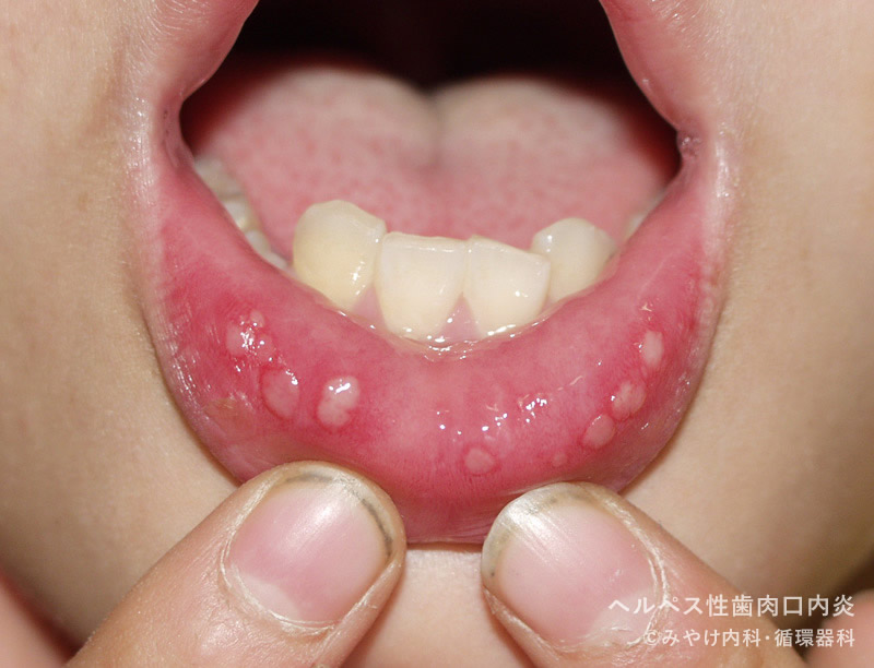ヘルペス性（歯肉）口内炎-写真03　口唇の口内炎