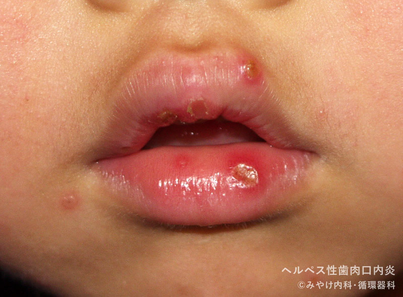 ヘルペス性（歯肉）口内炎-写真04　口唇の口内炎