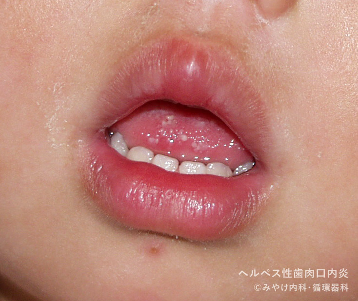 ヘルペス性（歯肉）口内炎-写真05　口唇の発赤・腫脹