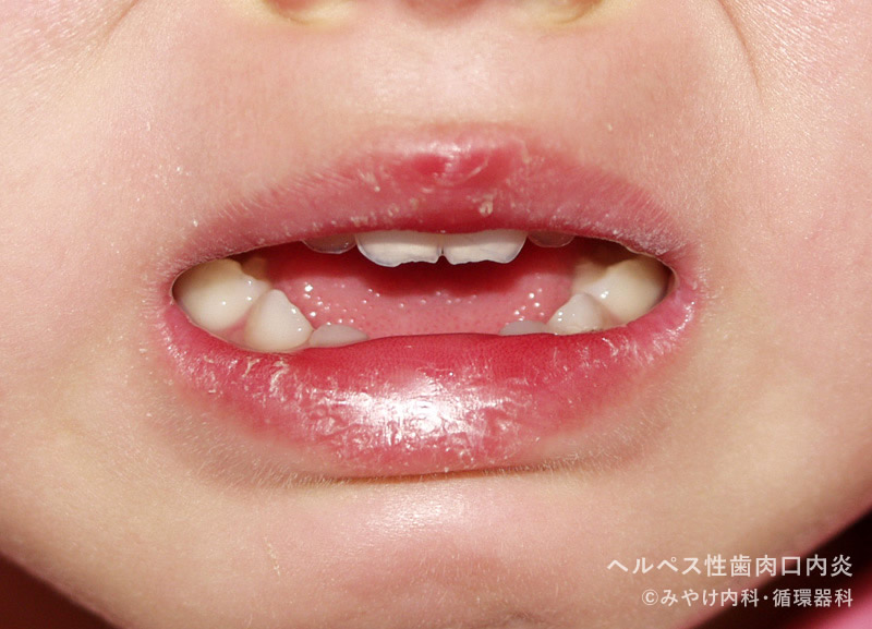 ヘルペス性（歯肉）口内炎-写真06　口唇の発赤・腫脹