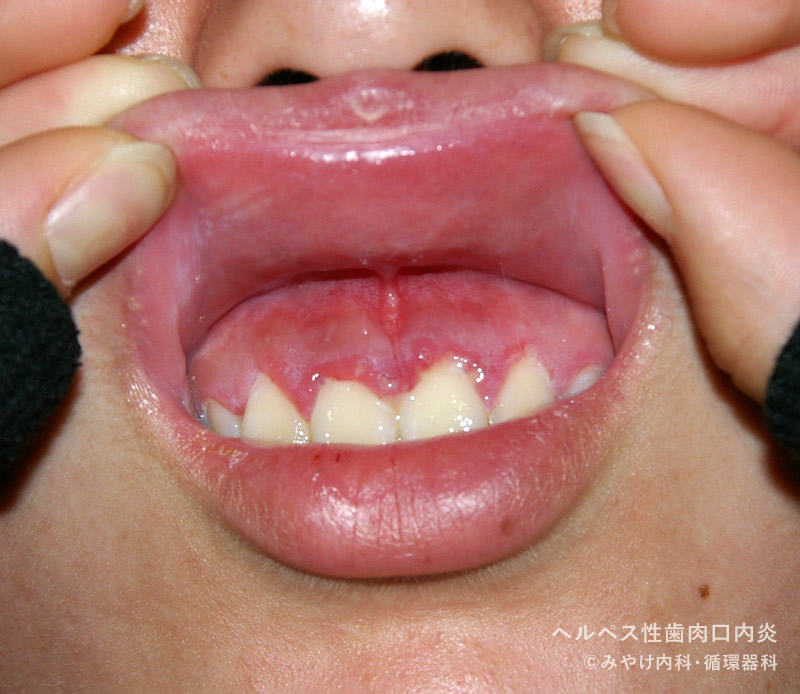 ヘルペス性（歯肉）口内炎-写真08　歯肉の発赤・腫脹