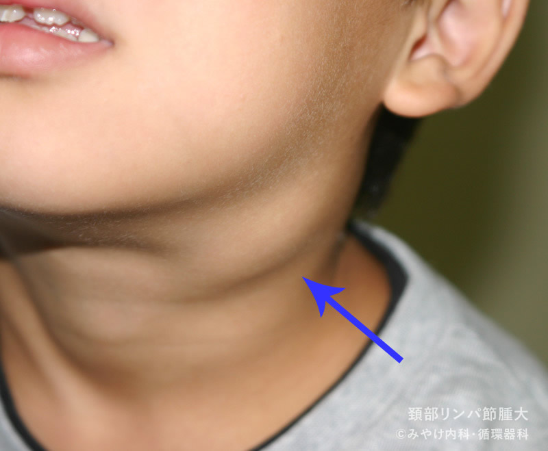 写真で見る「子供の病気」：頚部リンパ節腫大