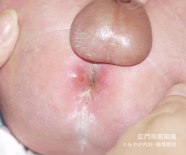 周囲 膿瘍 肛門