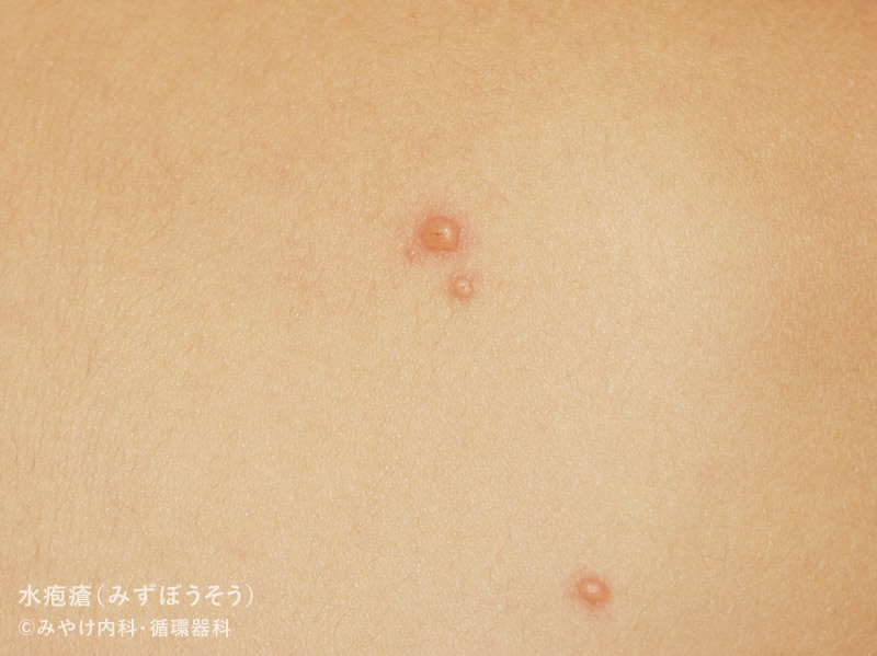 （写真2）水痘・水疱瘡の水疱