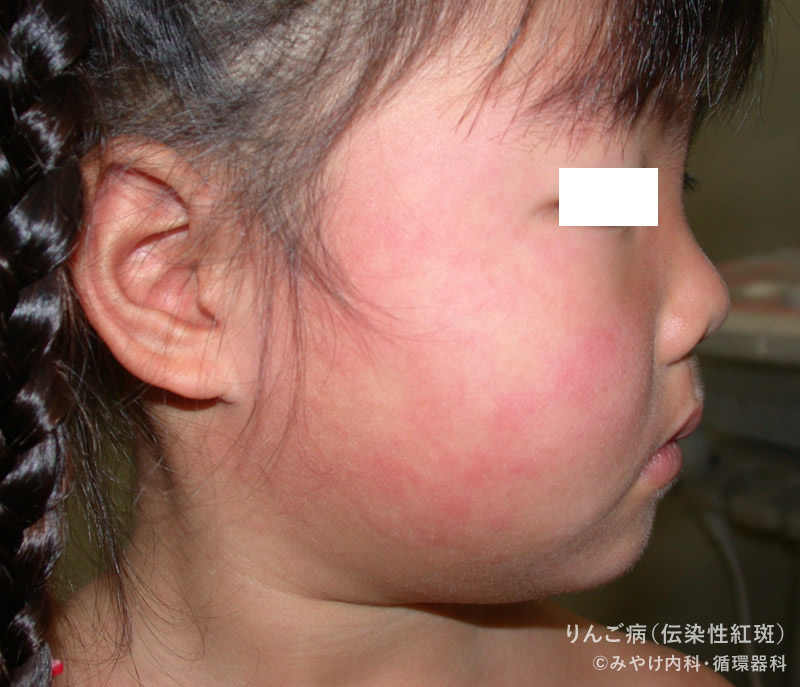 りんご病（伝染性紅斑）の顔の発疹