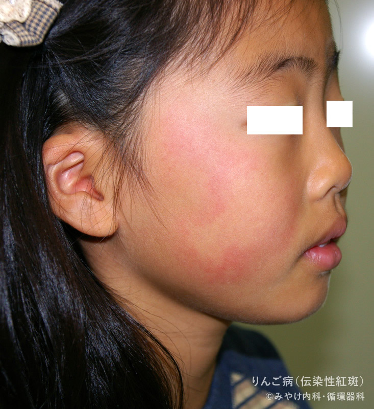 りんご病（伝染性紅斑）の顔の発疹