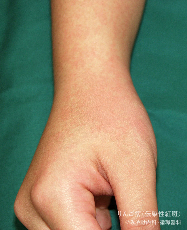 りんご病（伝染性紅斑）の手の発疹