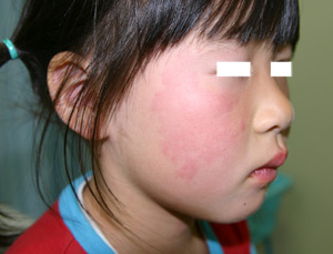 写真で見る子どもの病気：りんご病（伝染性紅斑）の詳しい説明