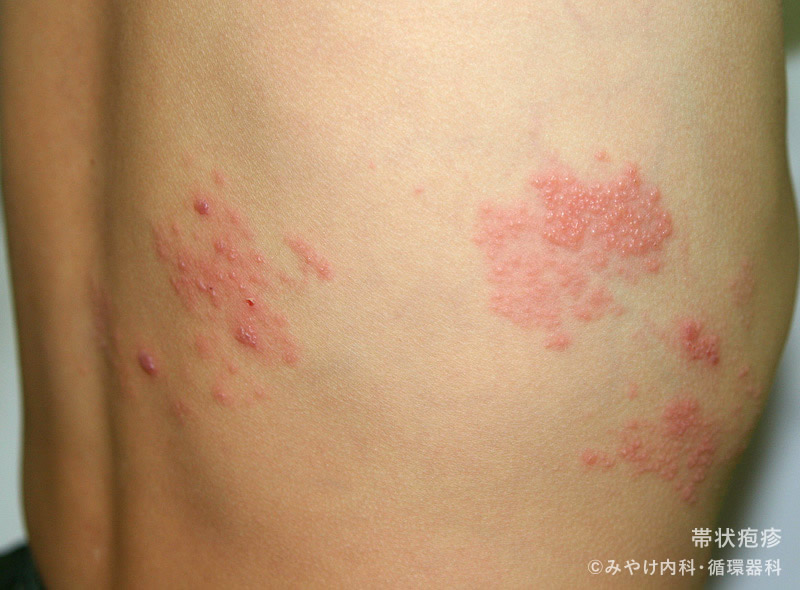 帯状疱疹の子供の世話をする方法