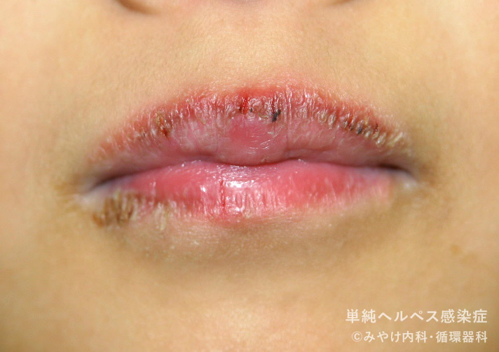 単純ヘルペス感染症-写真12　口唇ヘルペス