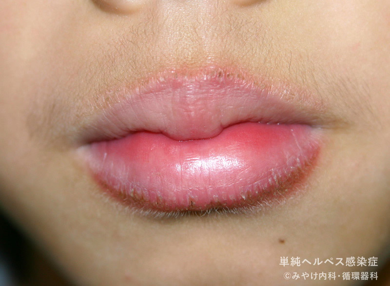 単純ヘルペス感染症-写真13　口唇ヘルペス