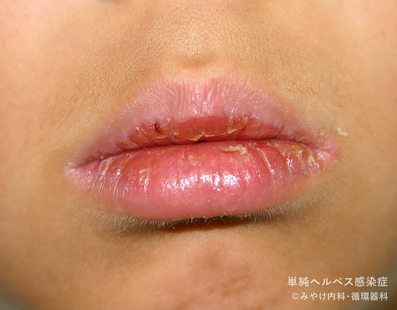 単純ヘルペス感染症-写真14　口唇ヘルペス