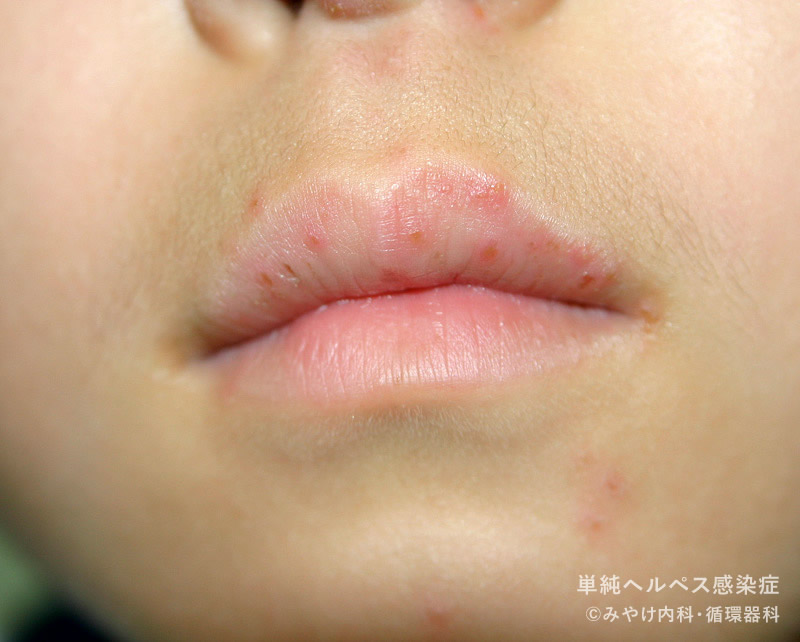 単純ヘルペス感染症-写真15　口唇ヘルペス