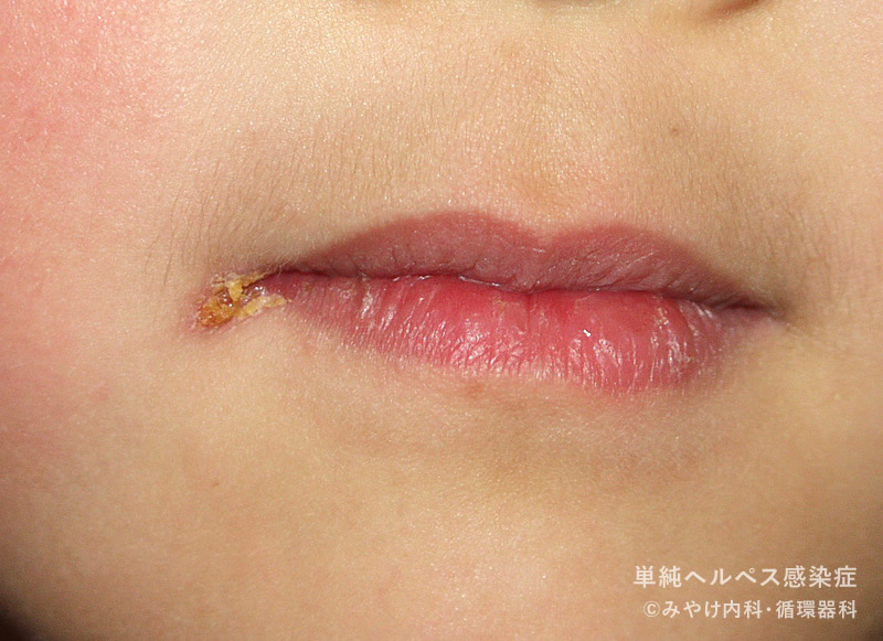 単純ヘルペス感染症-写真19　口唇ヘルペス