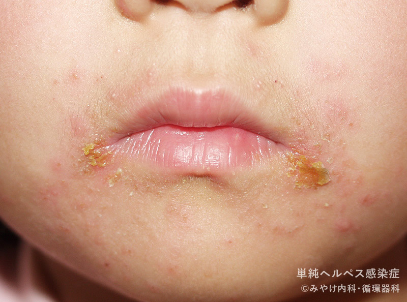 単純ヘルペス感染症-写真20　口唇ヘルペス