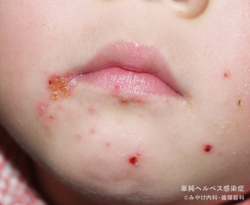 単純ヘルペス感染症-写真21　口唇ヘルペス