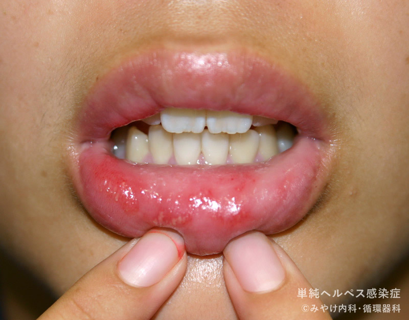 単純ヘルペス感染症-写真22　口唇ヘルペス