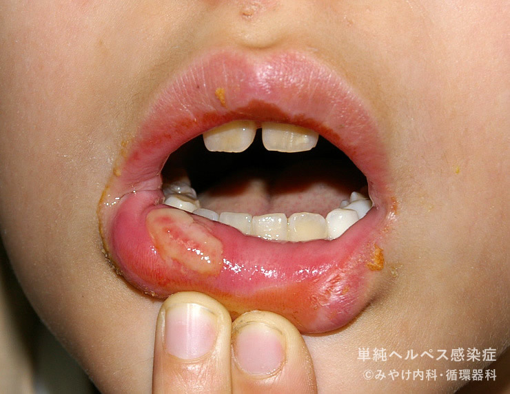 単純ヘルペス感染症-写真24　口唇ヘルペス