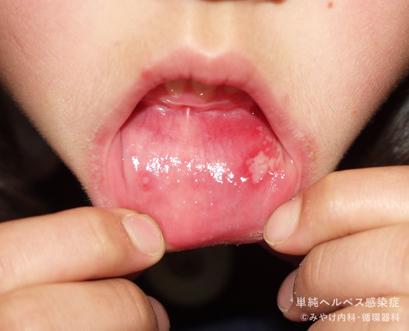 単純ヘルペス感染症-写真25　口唇ヘルペス