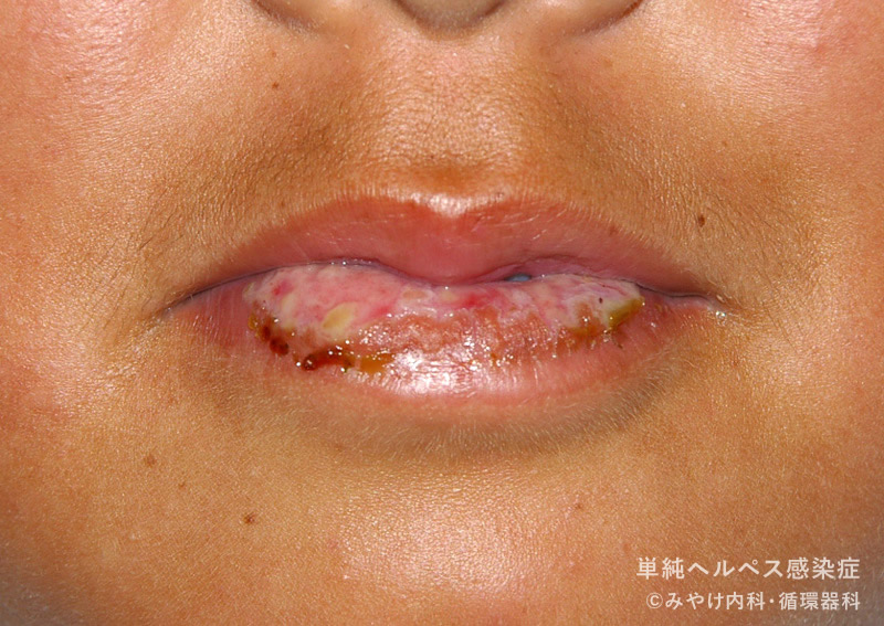 単純ヘルペス感染症-写真26　口唇ヘルペス