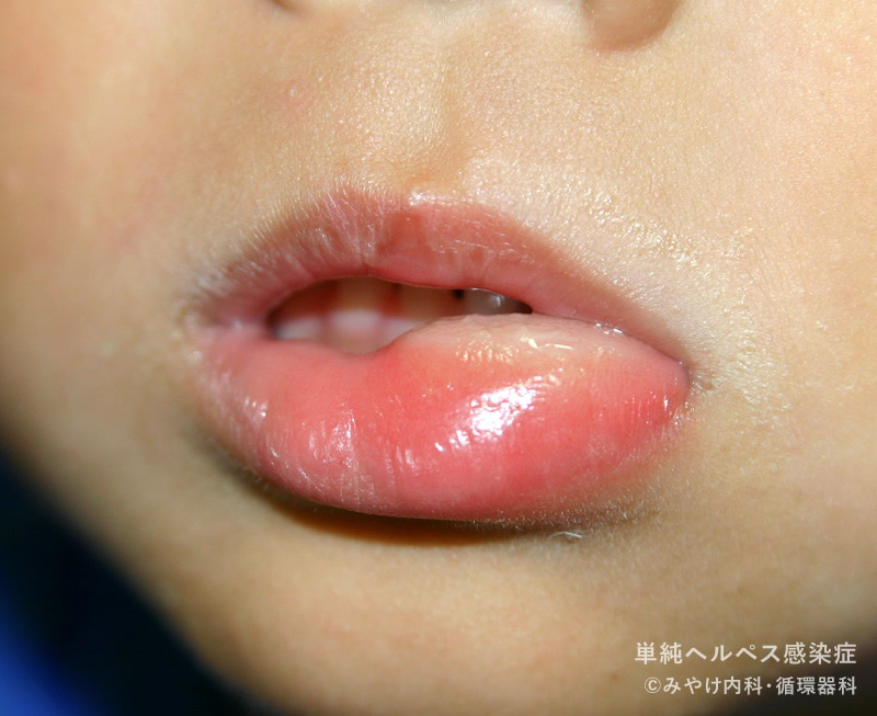 単純ヘルペス感染症-写真27　口唇ヘルペス