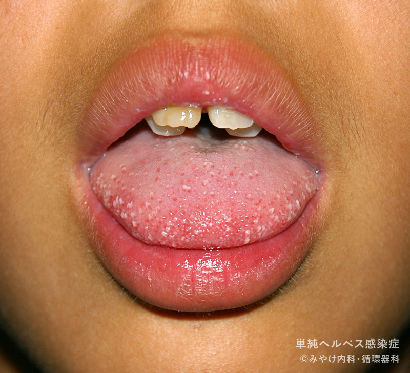 単純ヘルペス感染症-写真33　頬部、舌ヘルペス