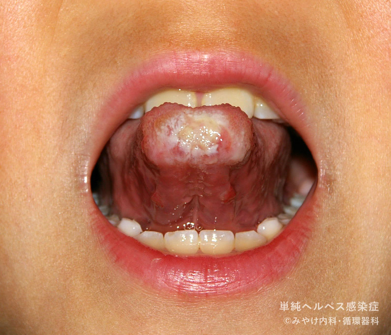 単純ヘルペス感染症-写真35　頬部、舌ヘルペス