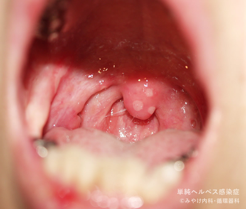 単純ヘルペス感染症-写真37　頬部、舌ヘルペス