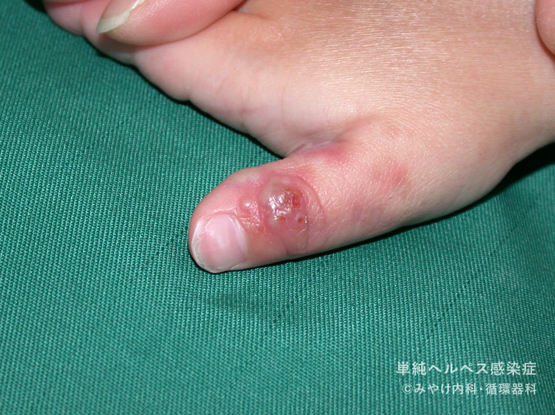 単純ヘルペス感染症-写真46　手足のヘルペス
