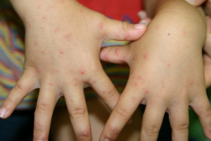 写真で見る「子どもの病気」：手足口病の詳しい説明と他の写真