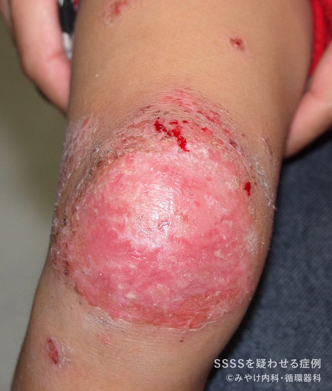 ブドウ球菌性熱傷様皮膚症候群(SSSS)