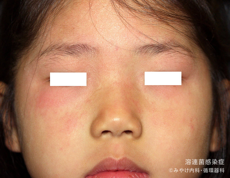 溶連菌感染症の顔の皮膚変化