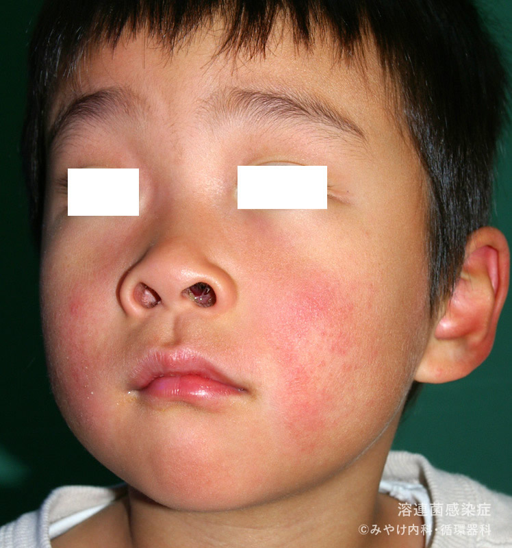溶連菌感染症の顔の皮膚変化