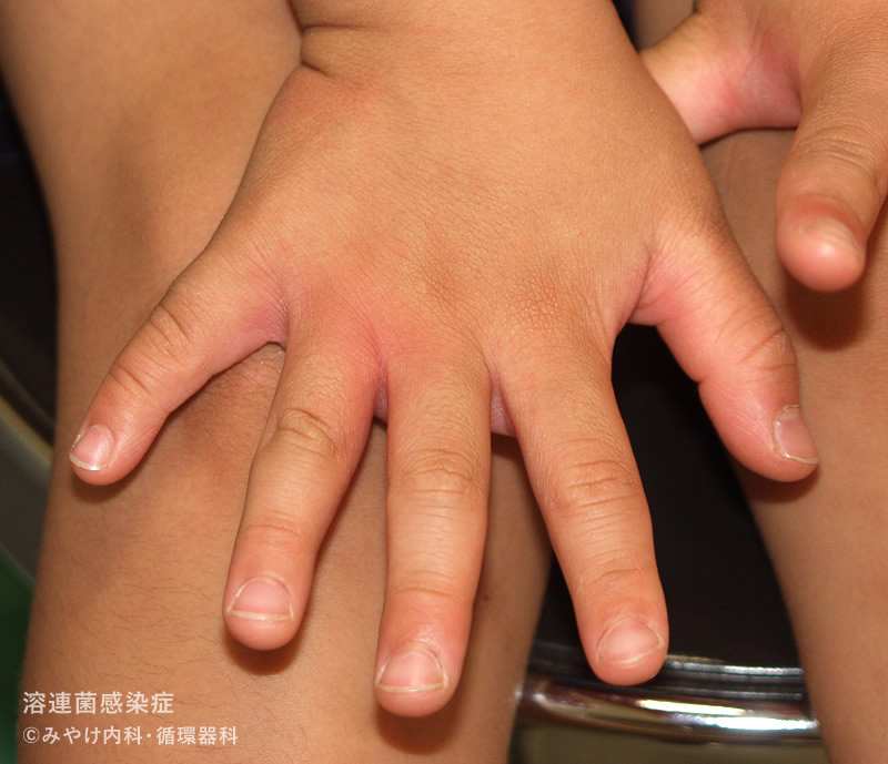 溶連菌感染症の手足の皮膚の変化