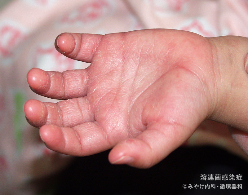 溶連菌感染症の手足の症状 写真で見る 子どもの病気 みやけ内科 循環器科