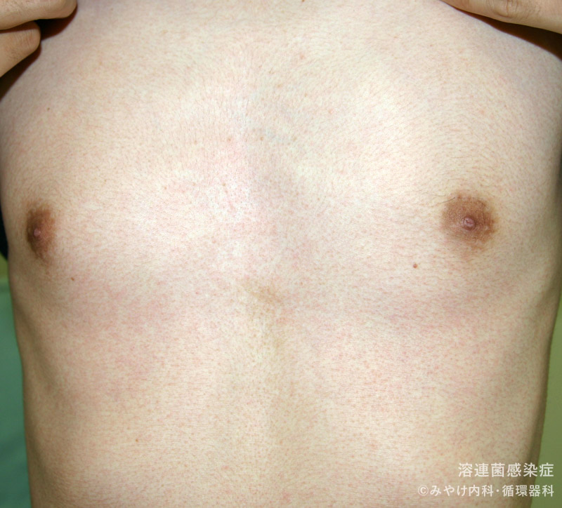 （写真10）溶連菌感染症のからだの皮膚変化