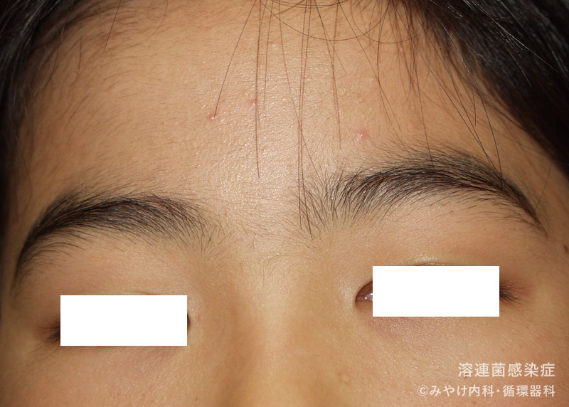 （写真5）溶連菌感染症の顔の皮膚変化