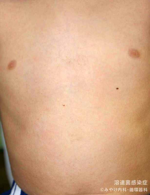 （写真7）溶連菌感染症のからだの皮膚変化