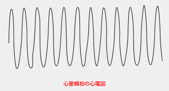 心室頻拍の心電図