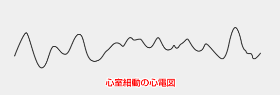 心室細動の心電図