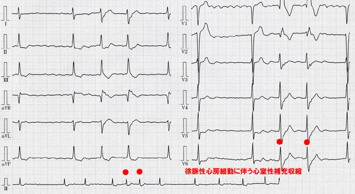 （心電図12）心室性補充収縮