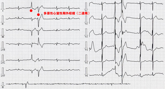 上 室 性 期 外 収縮
