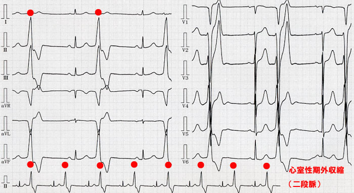 （心電図5）心室性期外収縮(二段脈)