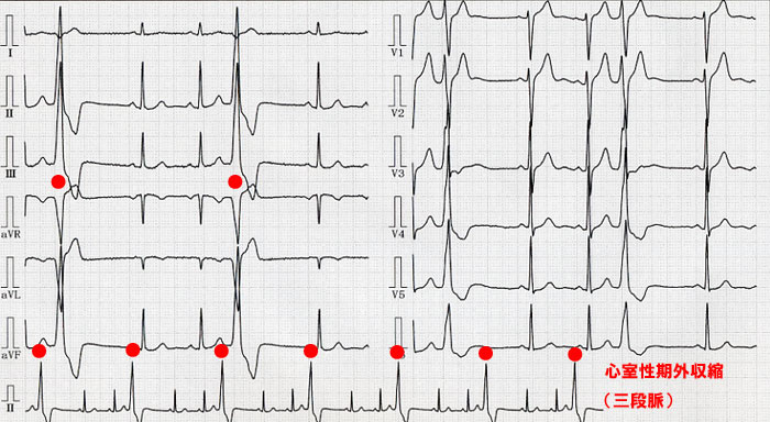 （心電図6）心室性期外収縮(三段脈)