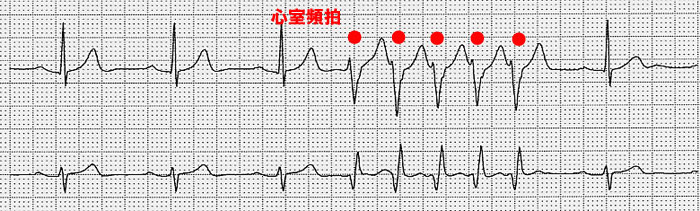 （心電図8）心室頻拍