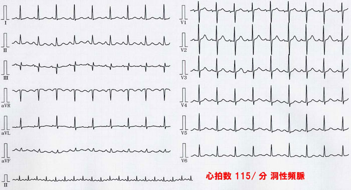 （心電図1）洞性頻脈
