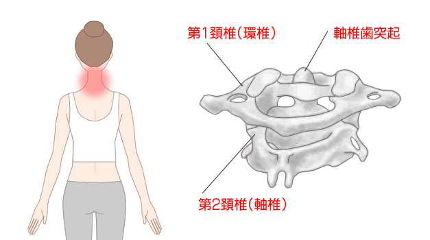 軸椎歯突起症候群(crowned dens syndrome)に伴う関節炎で生じる痛みの部位