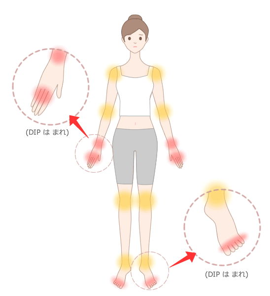 関節リウマチで生じる痛みの部位（※赤丸は主な関節痛の部位）