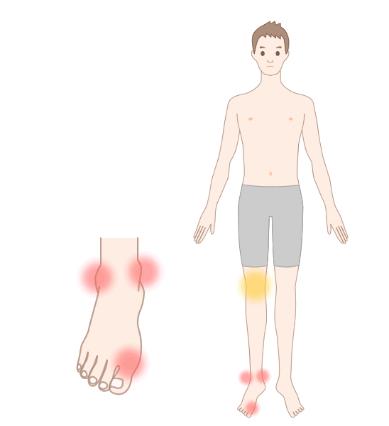 痛風で生じる痛みの部位（※赤丸は主な関節痛の部位）